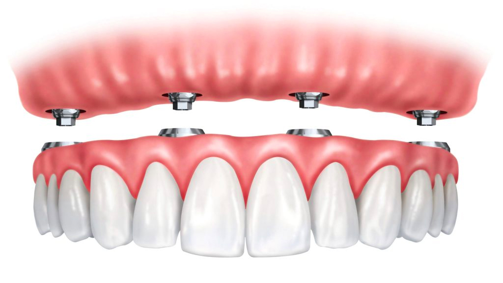 Dental Implant Dentures: The Benefits of a Permanent Smile